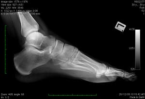 Avulsion Fracture