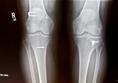 ACL Sprain by Doctor in Jaipur