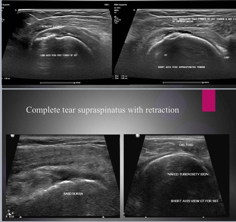 Rotator cuff tears