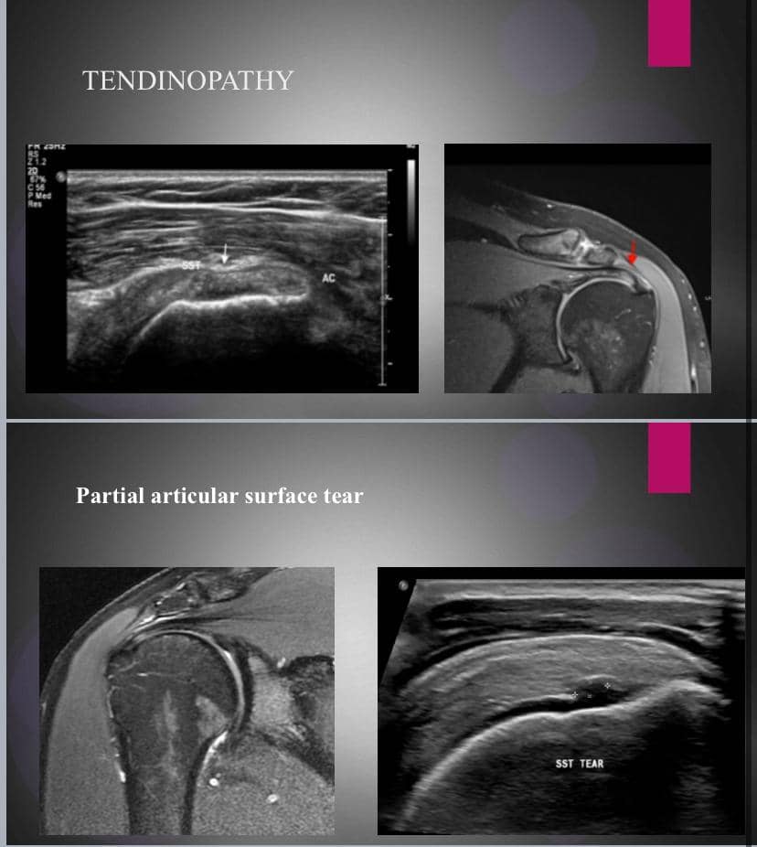 Rotator cuff tears